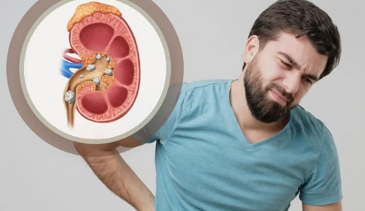 Vì sao nam giới dễ bị sỏi thận hơn nữ giới?