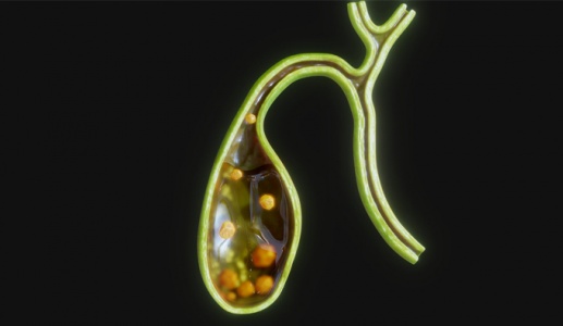 Có sỏi túi mật 21mm dùng TPBVSK Kim Đởm Khang được không?