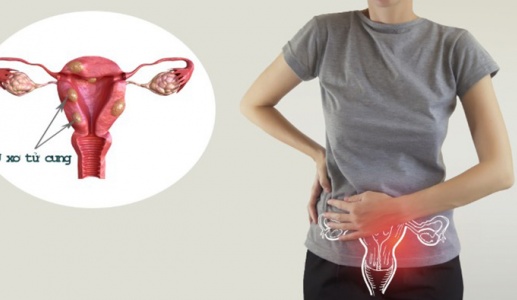 U xơ tử cung có gây hiếm muộn không?