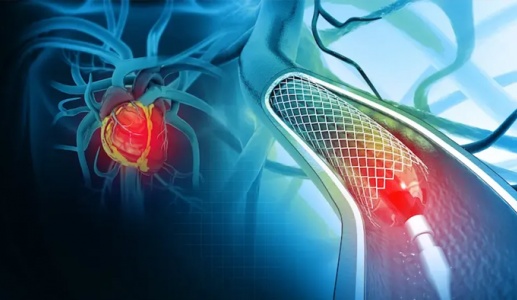 Sau can thiệp đặt stent mạch vành: Bao lâu có thể làm việc trở lại?