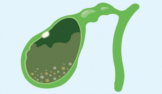 Có polyp túi mật và sỏi bùn túi mật cần cẩn trọng gì?