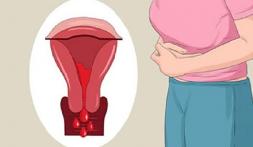 Dấu hiệu u xơ tử cung dưới niêm mạc giúp chị em “bắt” bệnh sớm