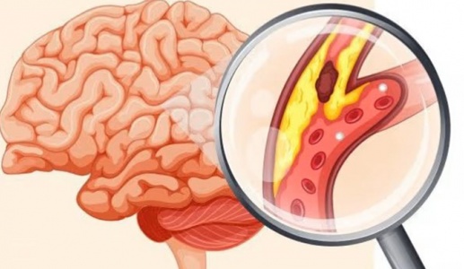 Những ai dễ bị nhồi máu não?