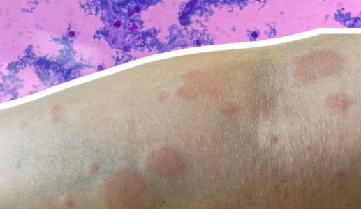 Lupus ban đỏ dạng đĩa ảnh hưởng thế nào đến cơ thể và làn da?