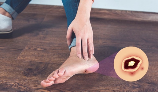 Bạn cần biết gì về biến chứng bàn chân do đái tháo đường?