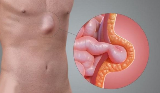 Làm thế nào để tự đánh giá nguy cơ mắc thoát vị?