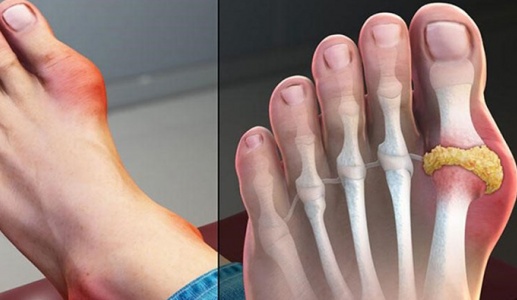 Bệnh gout cấp có chữa khỏi được không?