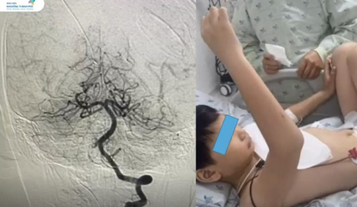 Bé trai 10 tuổi suýt liệt nửa người sau khi đi chơi cầu lông