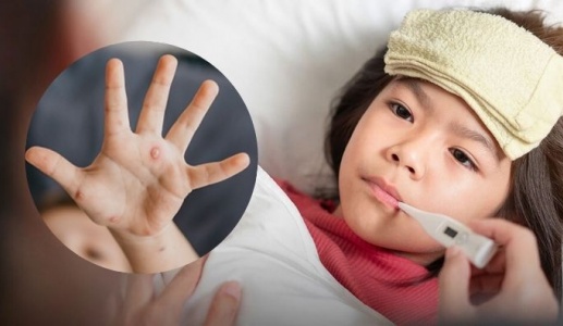 Bệnh thủy đậu là gì và cách điều trị ra sao? 