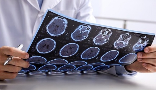 3 yếu tố làm tăng nguy cơ tử vong do bệnh đa xơ cứng