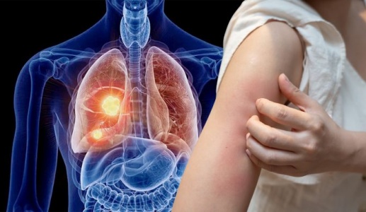 Dấu hiệu ngoài da cảnh báo u phổi