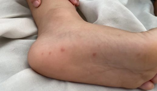 Ca bệnh tay chân miệng tăng gấp 5 lần, Bộ Y tế yêu cầu siết chặt kiểm soát