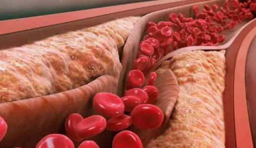 Xơ vữa động mạch hình thành như thế nào?  