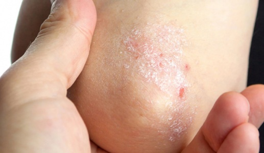 Cây sói rừng - thảo dược hỗ trợ cải thiện bệnh vảy nến hiệu quả