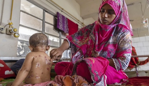 Bangladesh: Gần 100 trẻ em tử vong nghi do dịch sởi bùng phát