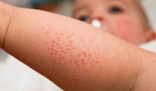 Bệnh sởi và nguy cơ suy giảm miễn dịch