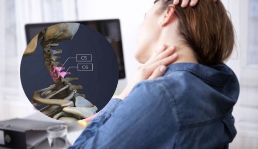 Thoát vị đĩa đệm C5-C6 phải làm sao?