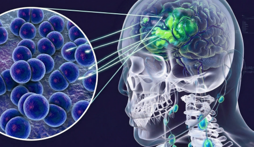 4 trường hợp tử vong do mắc viêm não mô cầu, Bộ Y tế phát cảnh báo