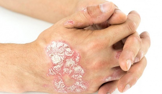 Bị vảy nến thể mảng cần lưu ý những gì?