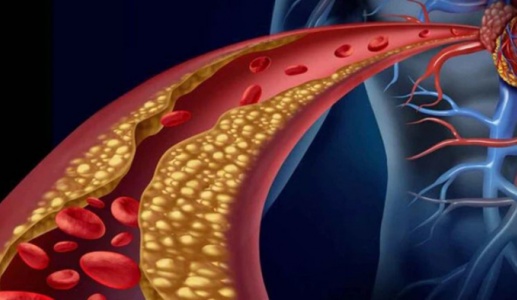 Rối loạn lipid máu có chữa khỏi được không?