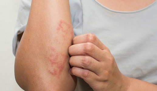 Viêm mao mạch dị ứng ở trẻ em có nguy hiểm không?