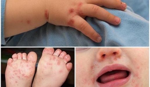 Sốt xuất huyết và tay chân miệng cùng gia tăng mạnh