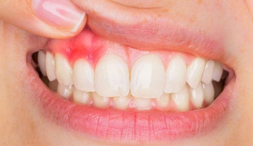 Mách bạn 5 cách cải thiện viêm lợi tại nhà