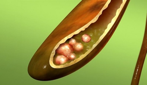 Sỏi bùn túi mật 7mm kèm đái tháo đường: Dùng TPBVSK Kim Đởm Khang được không?