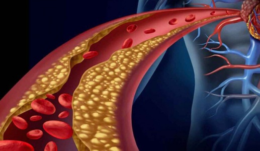 Rối loạn lipid máu: Nhận diện nguy cơ và giải pháp kiểm soát an toàn