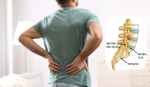 Triệu chứng cảnh báo thoát vị đĩa đệm lưng không nên bỏ qua