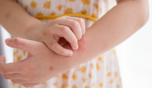 Giải pháp thảo dược cho trẻ bị nổi mề đay