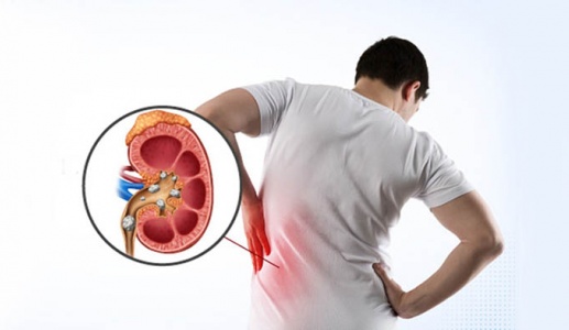 Chế độ ăn uống giúp ngăn sỏi thận tái phát