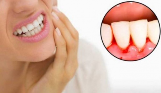 Chảy máu chân răng cảnh báo bệnh gì?