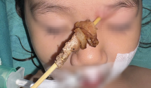 Bé gái 2 tuổi suýt mù mắt, tổn thương não khi ăn thịt xiên nướng