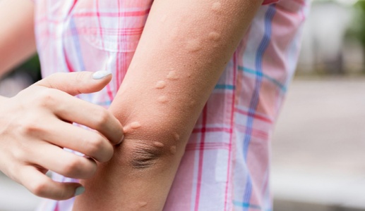 Nổi mề đay mùa Hè, phải làm sao?