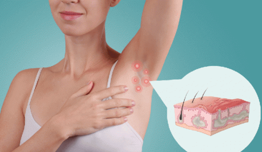 Sống chung với viêm tuyến mồ hôi mủ trong mùa Hè