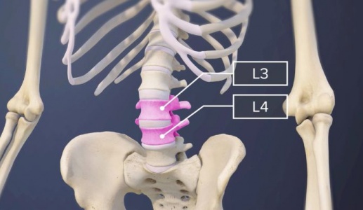 Dấu hiệu nhận biết thoát vị đĩa đệm L3 L4