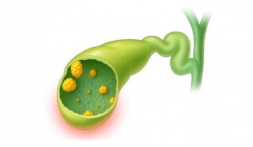 Polyp túi mật 14mm có nguy hiểm không?