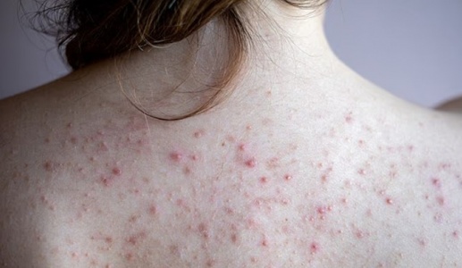 Bị mụn lưng phải làm sao?