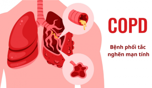 Cách nhận biết sớm bệnh phổi tắc nghẽn mạn tính (COPD)