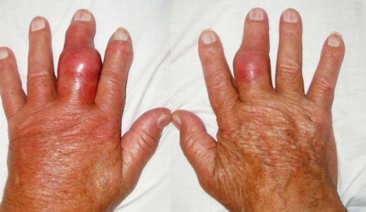 Hạt tophi xuất hiện ở người bệnh gout: Cảnh báo không nên chủ quan