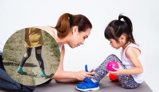 Khớp gối vẹo ngoài: Dáng đi bất thường ở trẻ cha mẹ nên theo dõi