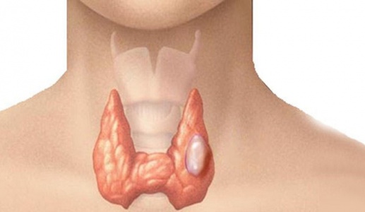 Bướu cổ đơn thuần có nguy hiểm không?