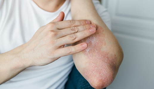 Nguyên nhân nào khiến vảy nến lan ra toàn thân?