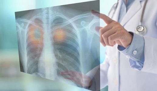 Dấu hiệu nhận biết u phổi lành tính và ác tính