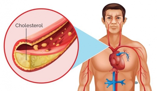 Bảo vệ trái tim trước mối nguy do tăng cholesterol