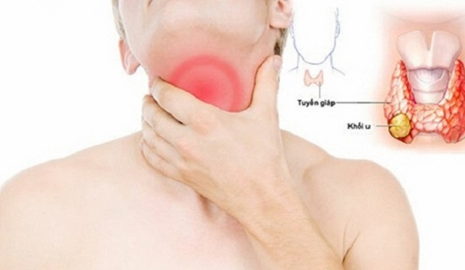 Có những loại bướu tuyến giáp nào?
