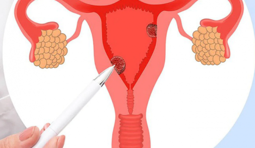 Vì sao PMOS gây thèm đồ ngọt?