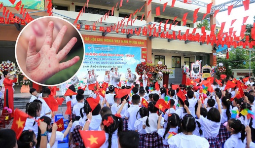 Bộ Y tế cảnh báo gia tăng bệnh tay chân miệng trong mùa tựu trường