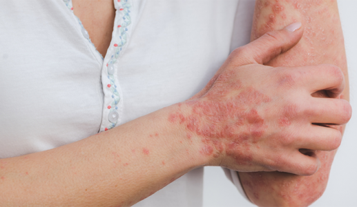 Những hiểu lầm khiến người bệnh vảy nến thêm tự ti